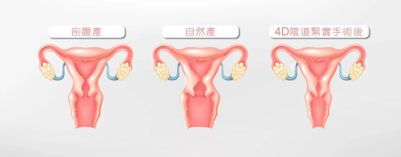 让性福加倍做紧致女人 阴道缩紧术超强攻略 熟女也能像少女那般紧窄如处